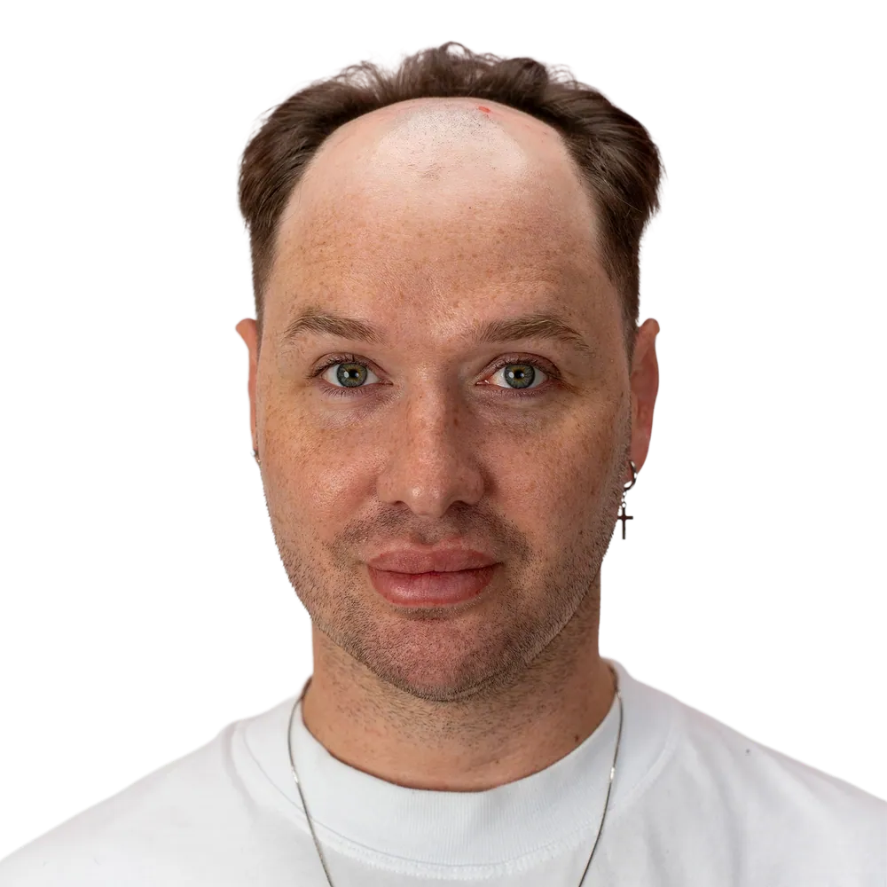 The same man photographed before the system, head and shoulders.